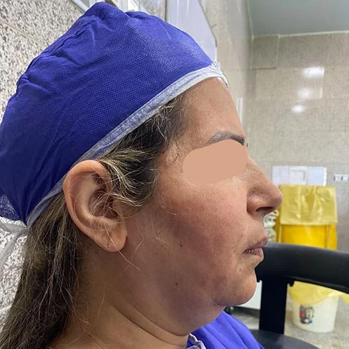 لیفت صورت قبل