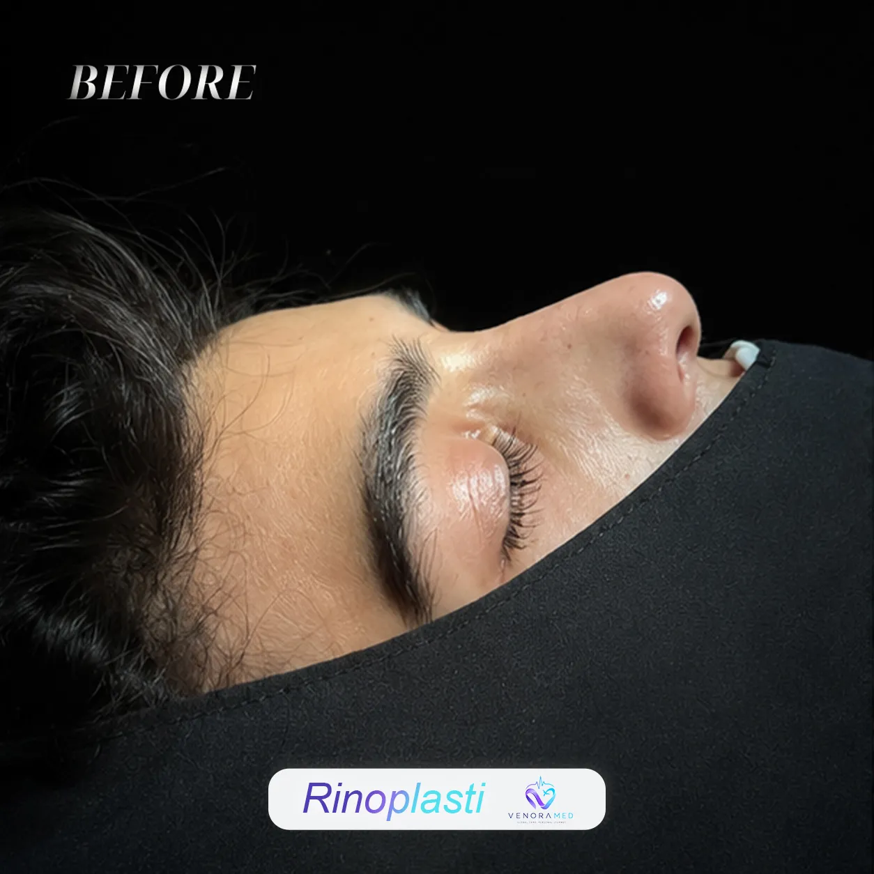 جراحی زیبایی بینی قبل