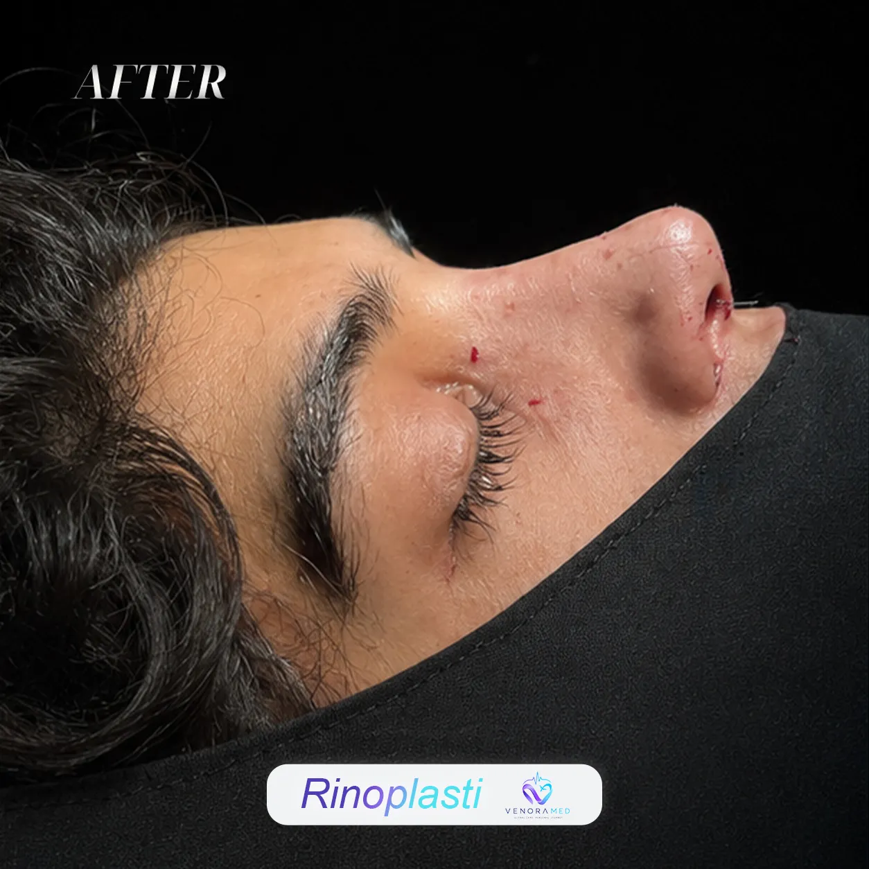 جراحی زیبایی بینی بعد