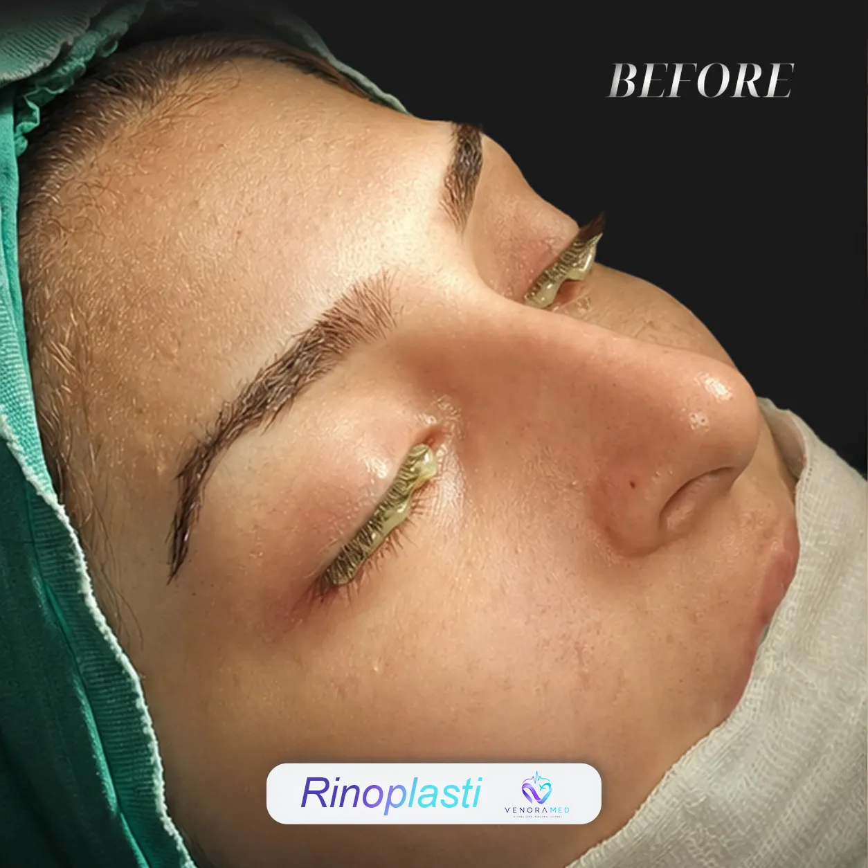 جراحی زیبایی بینی قبل