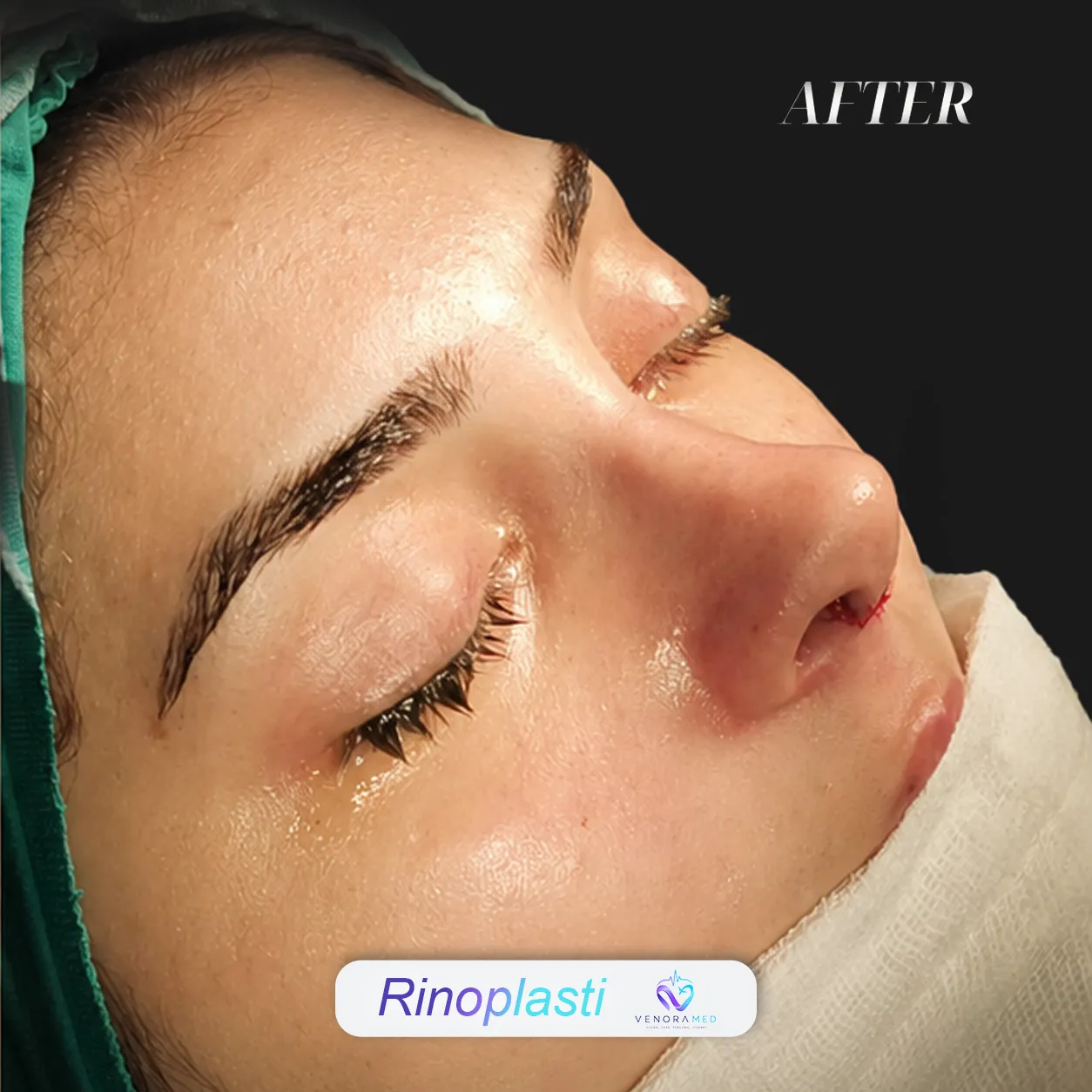 جراحی زیبایی بینی بعد