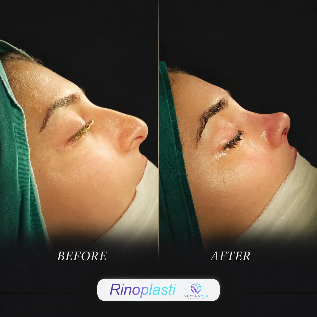 جراحی زیبایی بینی